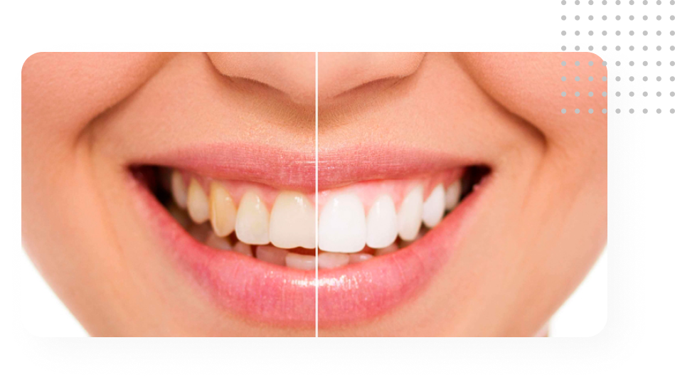 Imagem Clareamento Dental